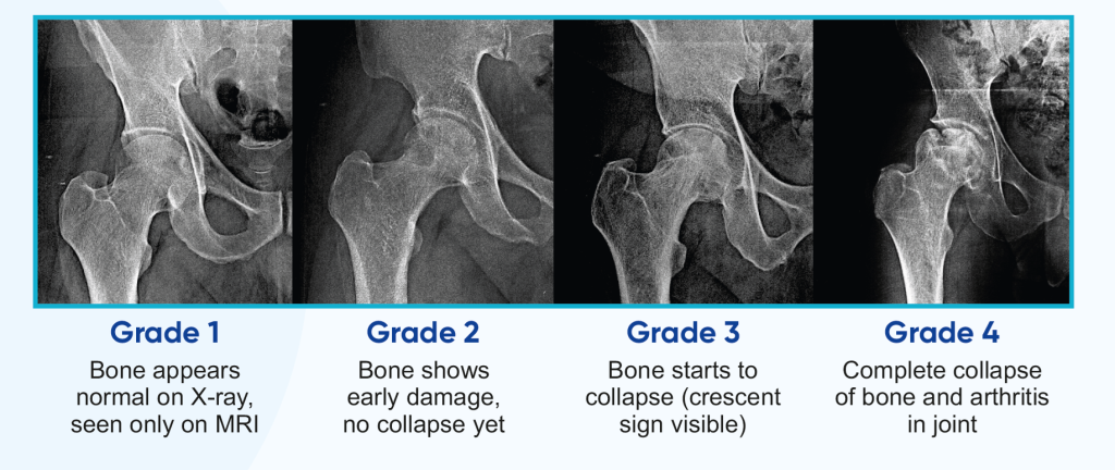 Diagram showing AVN hip grades 1 to 4, from early bone damage to complete femoral head collapse