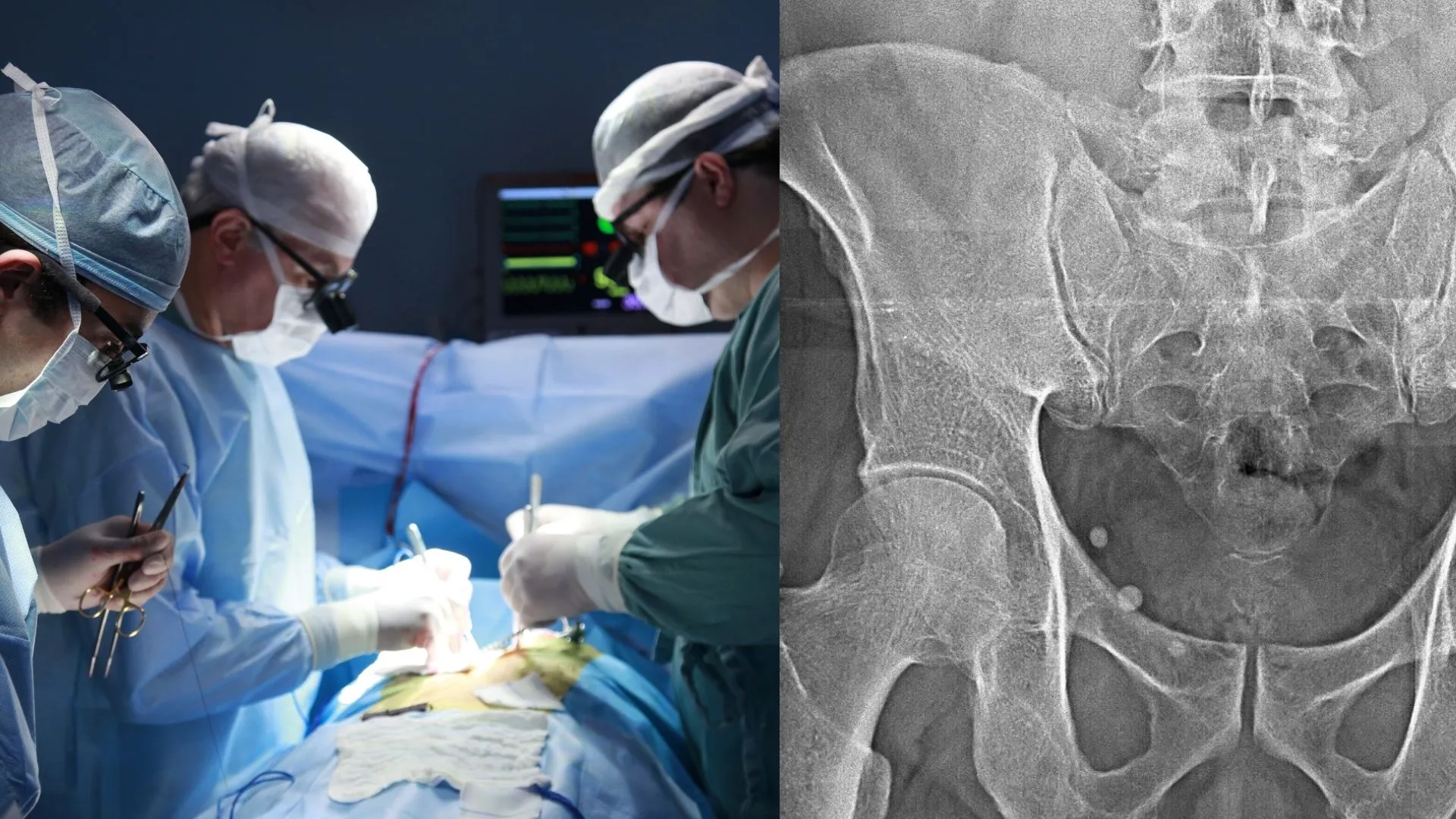 Osteonecrosis