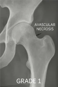 avn treatment grade 1