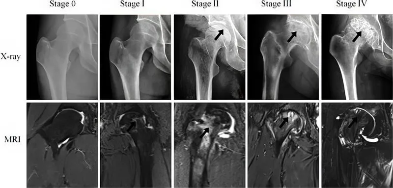 avn 4 stages image