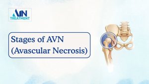 Stages of AVN (avascular necrosis) illustrated in the hip joint