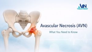 Avascular necrosis (AVN) shown in the hip joint, highlighting damage to the femoral head with surrounding pelvic bones in a medical illustration.