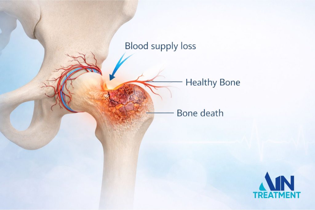 Illustration showing blood supply loss and bone tissue death in the hip joint in avascular necrosis.